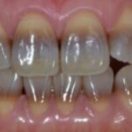 Тетрациклиновые зубы — что это?