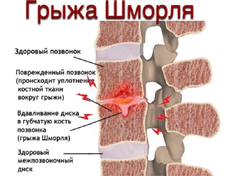 Что такое грыжа позвоночника фото