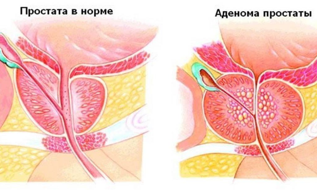 Простата в норме и аденома простаты