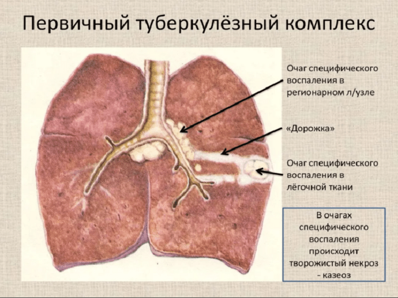 первичный туберкулёзный комплекс