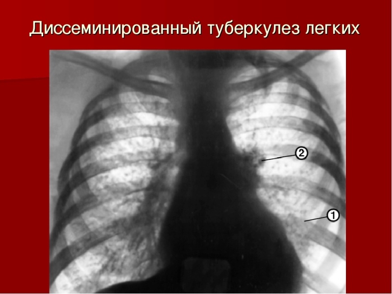 диссеминированный туберкулёз лёгких