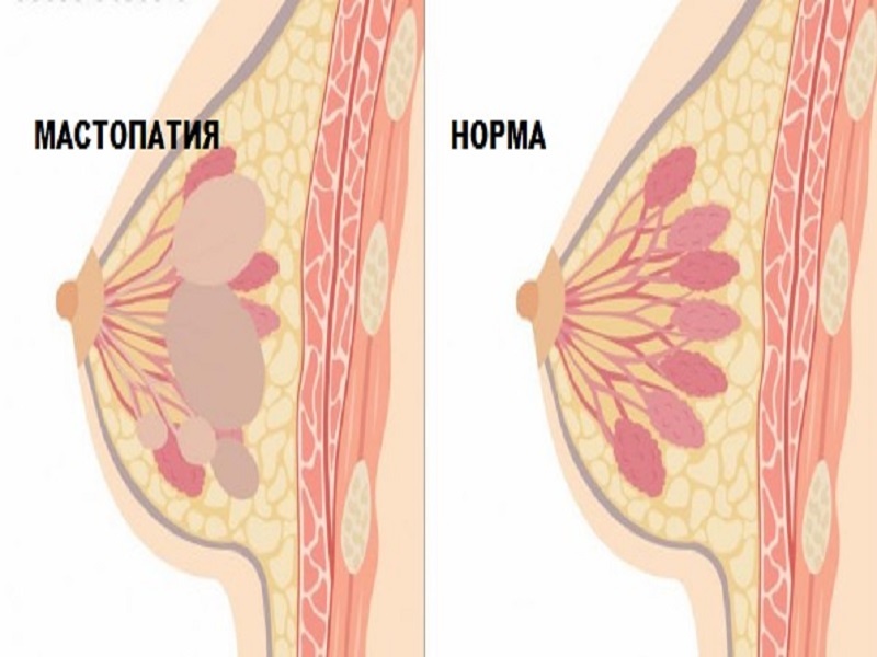 Как выглядит мастопатия молочных желез у женщин фото