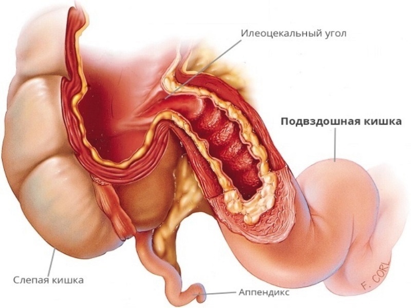 Колоноскопия аппендицит. Илеоцекальный клапан анатомия. Илеоцекальный клапан баугиниева заслонка. Подвздошная кишка анатомия. Илеоцекальный клапан толстой кишки.