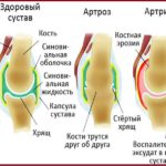 Болезни суставов — артрит, полиартрит, артроз